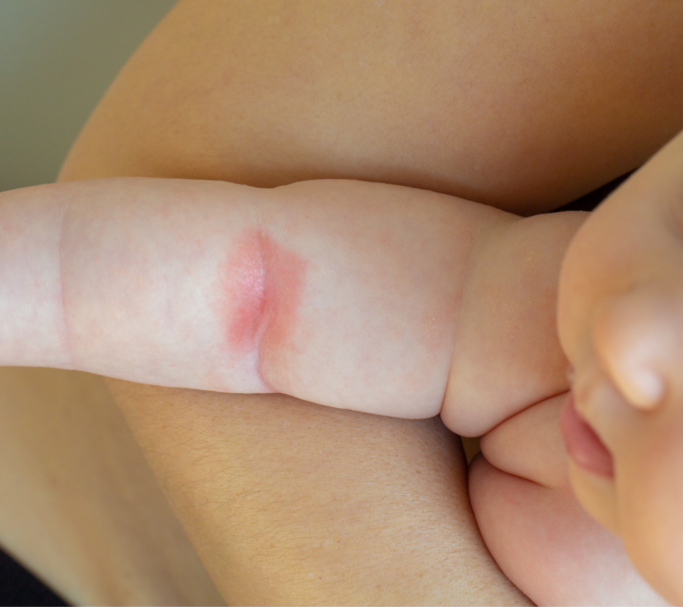sintomi dell’eczema infantile